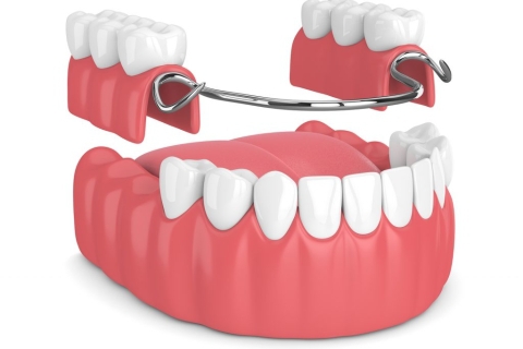 KHÁI QUÁT VỀ PHƯƠNG PHÁP TRỒNG RĂNG THÁO LẮP