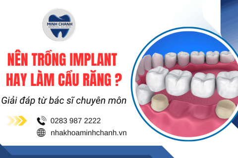 Nên trồng implant hay làm cầu răng? Phân tích đâu là phương án hiệu quả nhất