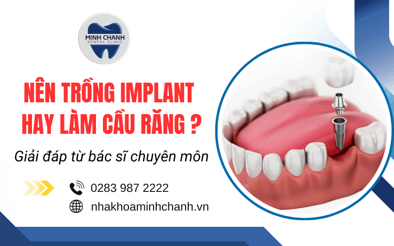 nên trồng implant hay làm cầu răng