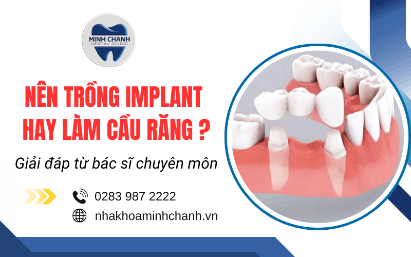 nên trồng implant hay làm cầu răng