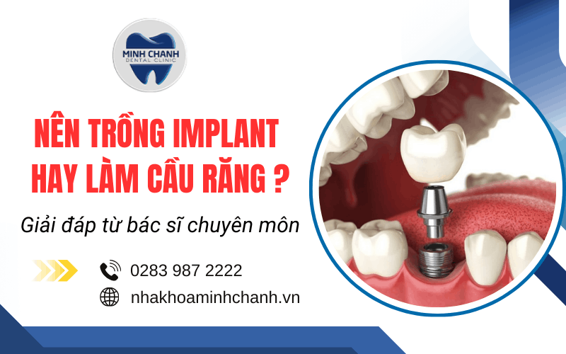 nên trồng implant hay làm cầu răng