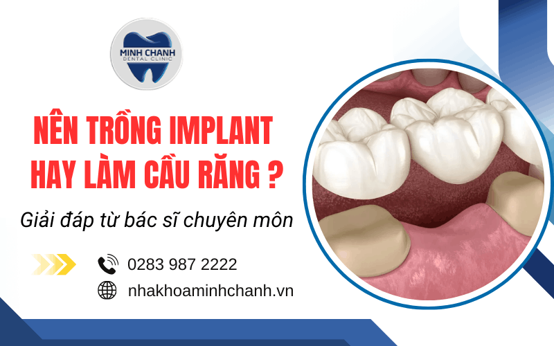 nên trồng implant hay làm cầu răng