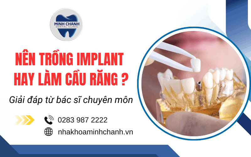nên trồng implant hay làm cầu răng