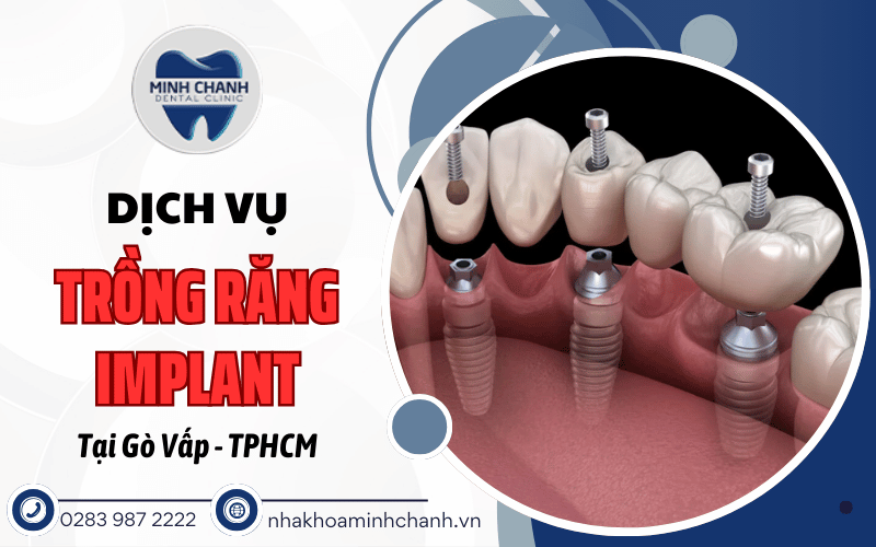trồng răng implant