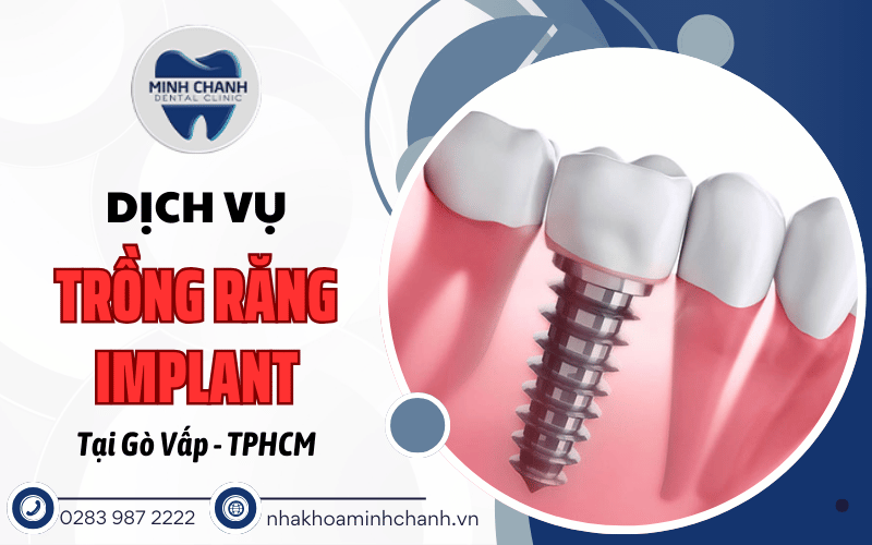 trồng răng implant